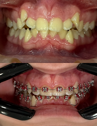 Resultado ortodontia 3 — 340x440px